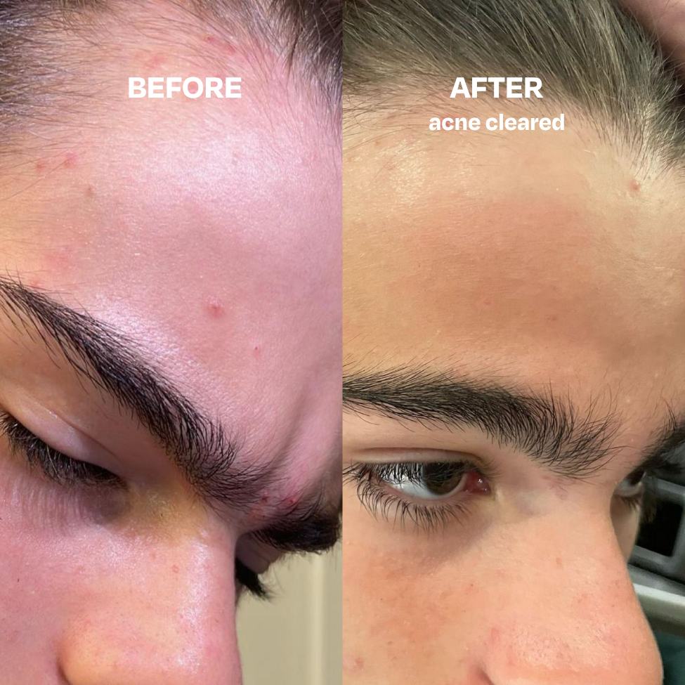 Skin Saver face and body spray with Hypochlorous Acid for clear, healthy skin