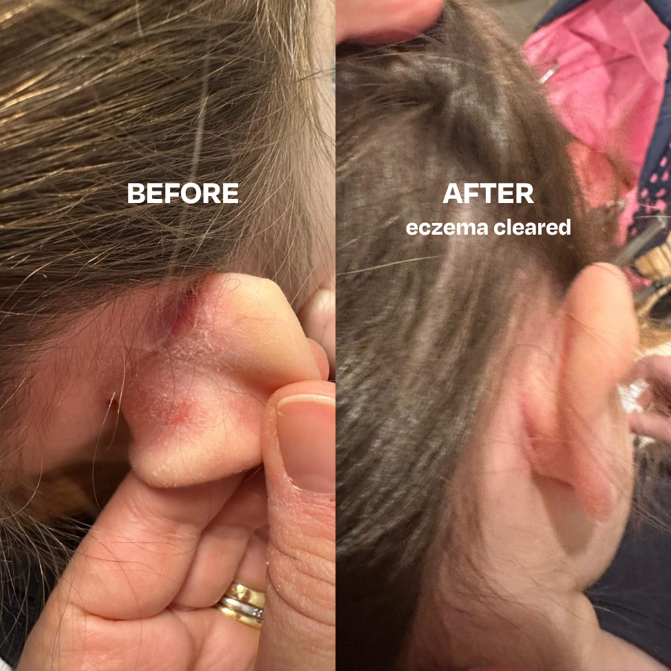 Skin Saver face and body spray with Hypochlorous Acid for acne and skin irritation relief