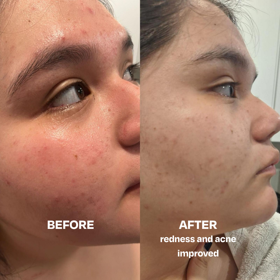 Skin Saver face and body spray with Hypochlorous Acid for acne and irritation relief